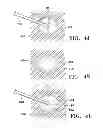 Fig. 10 - SUBCUTANEOUS CAVITY MARKING DEVICE AND METHOD