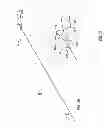 Fig. 15 - Occlusion perfusion catheter