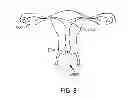 Fig. 15 - SPECIMEN REMOVAL BAG AND METHODS OF USING SAME