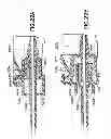 Fig. 23 - Flashback blood collection needle