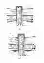 Fig. 05 - Percutaneous implant and ostomy method