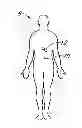 Fig. 01 - Integrated insulin delivery system with continuous glucose sensor