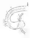 Fig. 02 - Guide extension catheter