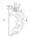 Fig. 02 - Patient-matched acetabular alignment tool