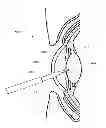 Fig. 01 - Phacoemulsification hook tip