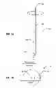 Fig. 02 - Phacoemulsification hook tip