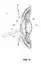 Fig. 07 - Phacoemulsification hook tip