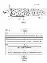 Fig. 13 - Devices and systems for thrombus treatment