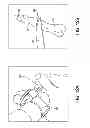 Fig. 09 - HAMMER TOE IMPLANT WITH LIVING HINGE AND METHOD