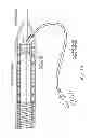 Fig. 19 - HANDLE ASSEMBLIES FOR STENT GRAFT DELIVERY SYSTEMS AND ASSOCIATED SYSTEMS AND METHODS