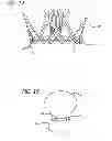 Fig. 09 - METHODS AND DEVICES FOR TREATMENT OF VASCULAR DEFECTS
