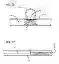 Fig. 10 - METHODS AND DEVICES FOR TREATMENT OF VASCULAR DEFECTS