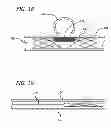 Fig. 11 - METHODS AND DEVICES FOR TREATMENT OF VASCULAR DEFECTS