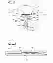 Fig. 13 - METHODS AND DEVICES FOR TREATMENT OF VASCULAR DEFECTS