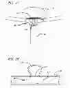 Fig. 16 - METHODS AND DEVICES FOR TREATMENT OF VASCULAR DEFECTS