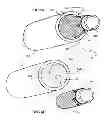 Fig. 05 - Devices and methods for deploying implantable sleeves over blood vessels
