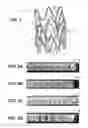 Fig. 02 - Stent retained on a balloon catheter