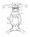 Fig. 01 - Reduced-strain extra-vascular ring for treating aortic aneurysm