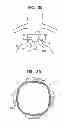 Fig. 05 - Reduced-strain extra-vascular ring for treating aortic aneurysm