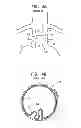 Fig. 06 - Reduced-strain extra-vascular ring for treating aortic aneurysm