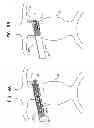 Fig. 10 - Reduced-strain extra-vascular ring for treating aortic aneurysm