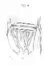 Fig. 05 - Sutureless anchoring device for cardiac valve prostheses