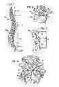 Fig. 02 - Crossbar spinal prosthesis having a modular design and related implantation methods