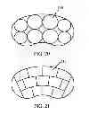 Fig. 10 - Inflatable multi-chambered devices and methods of treatment using the same