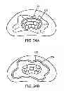 Fig. 12 - Inflatable multi-chambered devices and methods of treatment using the same