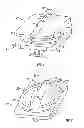 Fig. 02 - Transforaminal prosthetic spinal disc replacement