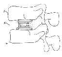 Fig. 01 - Expandable fusion device and method of installation thereof