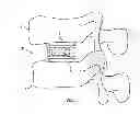 Fig. 02 - Expandable fusion device and method of installation thereof
