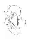 Fig. 30 - Expandable interbody spacer