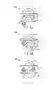 Fig. 06 - Stand alone interbody fixation system