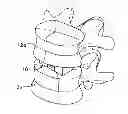 Fig. 01 - Intervertebral implant having extendable bone fixation members