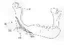Fig. 01 - Porous, Stabilized Craniomaxillofacial Implants and Methods and Kits Relating Thereto
