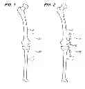 Fig. 02 - EXTRA-ARTICULAR IMPLANTABLE MECHANICAL ENERGY ABSORBING ASSEMBLIES HAVING TWO DEFLECTING MEMBERS AND METHODS