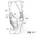Fig. 07 - EXTRA-ARTICULAR IMPLANTABLE MECHANICAL ENERGY ABSORBING ASSEMBLIES HAVING TWO DEFLECTING MEMBERS AND METHODS