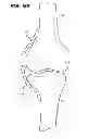 Fig. 10 - EXTRA-ARTICULAR IMPLANTABLE MECHANICAL ENERGY ABSORBING ASSEMBLIES HAVING TWO DEFLECTING MEMBERS AND METHODS