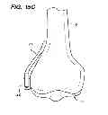 Fig. 11 - EXTRA-ARTICULAR IMPLANTABLE MECHANICAL ENERGY ABSORBING ASSEMBLIES HAVING TWO DEFLECTING MEMBERS AND METHODS