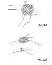 Fig. 14 - EXTRA-ARTICULAR IMPLANTABLE MECHANICAL ENERGY ABSORBING ASSEMBLIES HAVING TWO DEFLECTING MEMBERS AND METHODS