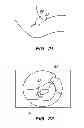 Fig. 16 - EXTRA-ARTICULAR IMPLANTABLE MECHANICAL ENERGY ABSORBING ASSEMBLIES HAVING TWO DEFLECTING MEMBERS AND METHODS