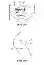 Fig. 17 - EXTRA-ARTICULAR IMPLANTABLE MECHANICAL ENERGY ABSORBING ASSEMBLIES HAVING TWO DEFLECTING MEMBERS AND METHODS