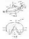 Fig. 03 - Tibial prosthesis