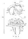 Fig. 08 - Tibial prosthesis