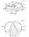 Fig. 09 - Tibial prosthesis