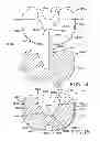 Fig. 10 - Tibial prosthesis