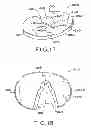 Fig. 12 - Tibial prosthesis