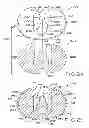Fig. 16 - Tibial prosthesis