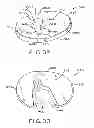 Fig. 21 - Tibial prosthesis